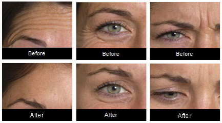 Anti-wrinkle treatment consultation