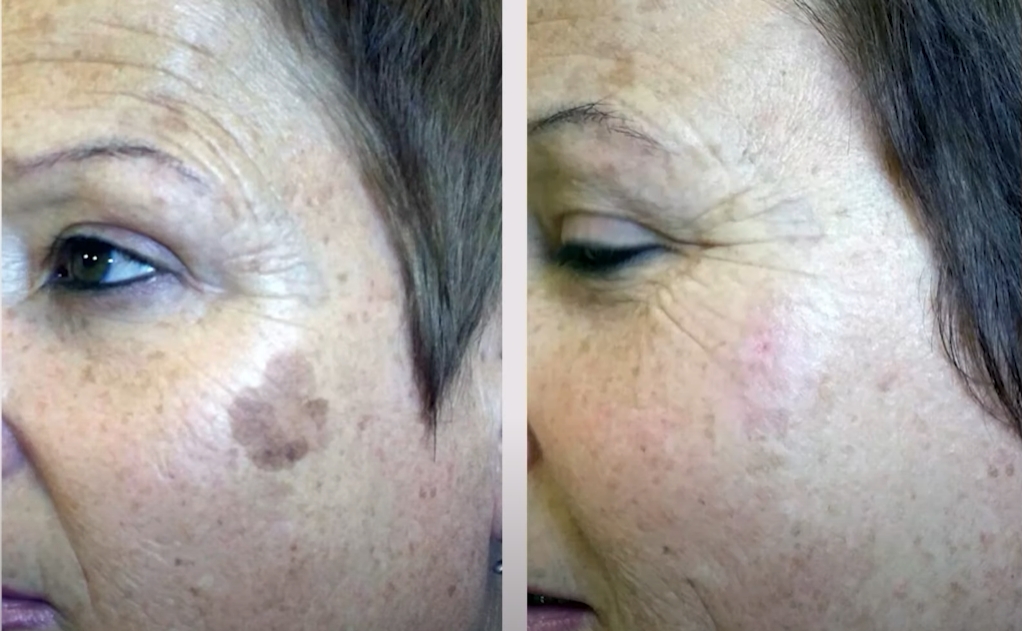 CryoPen treatment consultation imagery