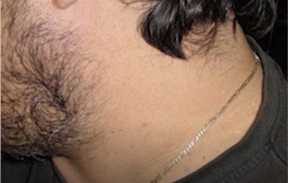 CryoPen treatment detail