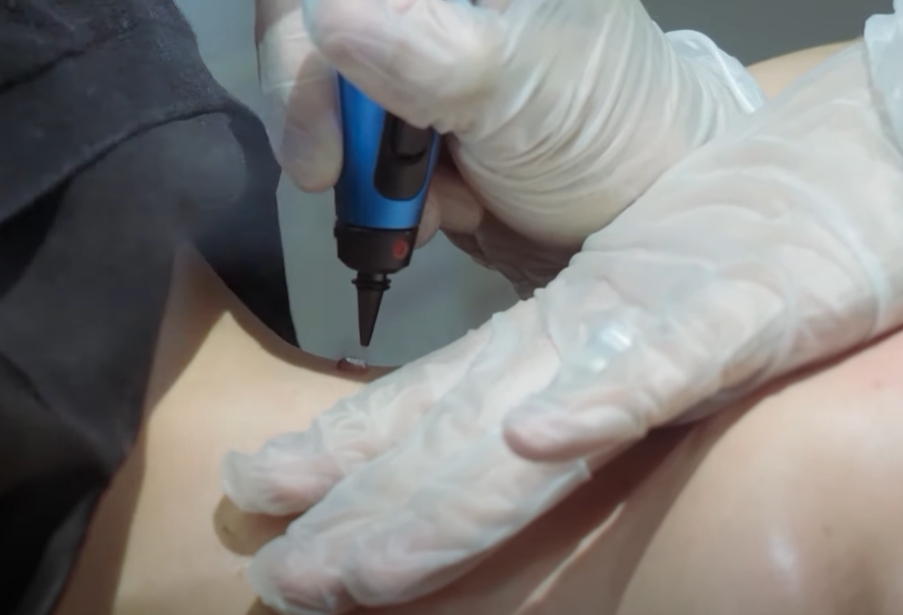 CryoPen treatment consultation imagery