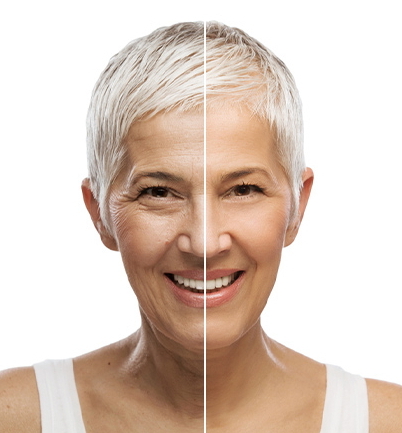 Smooth-looking skin after anti-wrinkle treatment