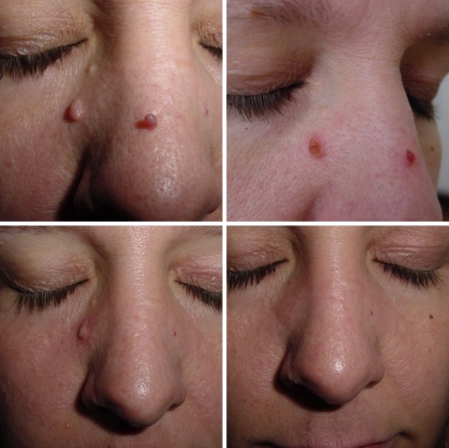 CryoPen treatment result image