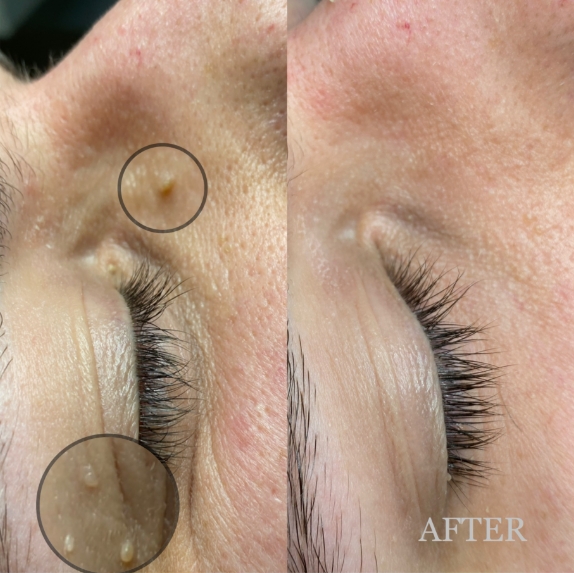 CryoPen treatment result image