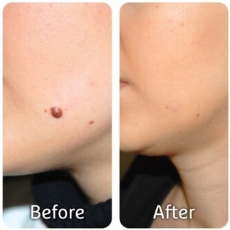CryoPen treatment result image