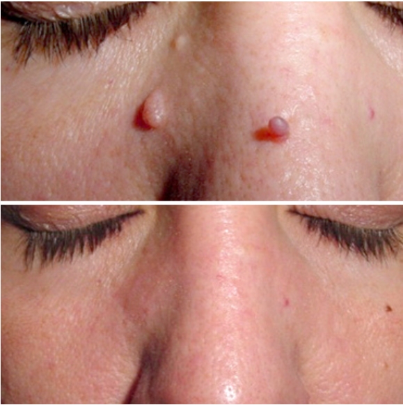 CryoPen treatment result image
