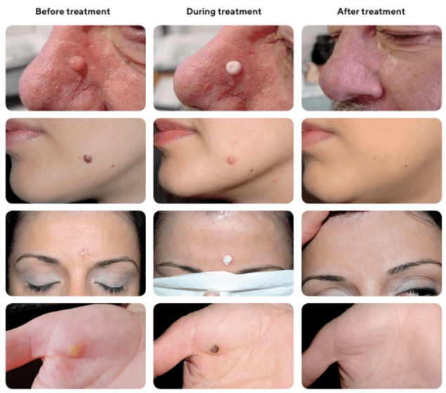 CryoPen treatment result image