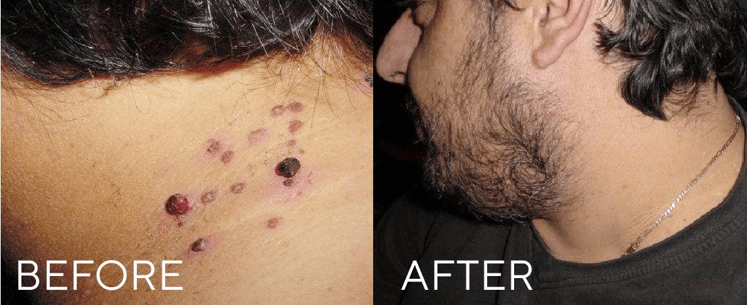 CryoPen treatment result image