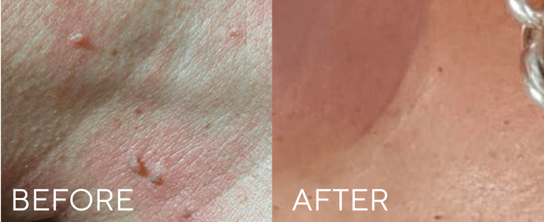 CryoPen treatment result image