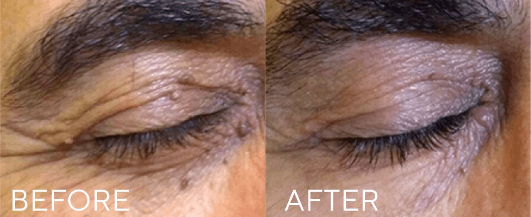 CryoPen treatment result image