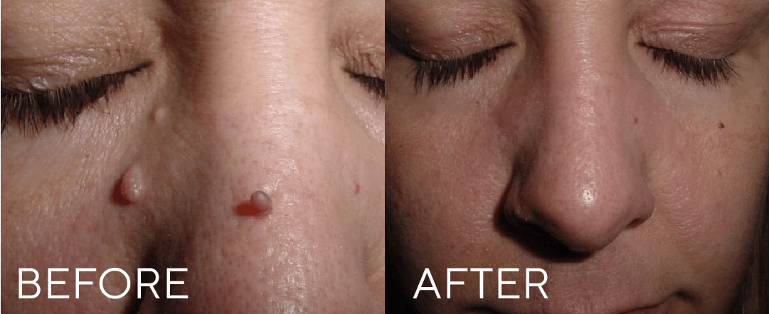 CryoPen treatment result image