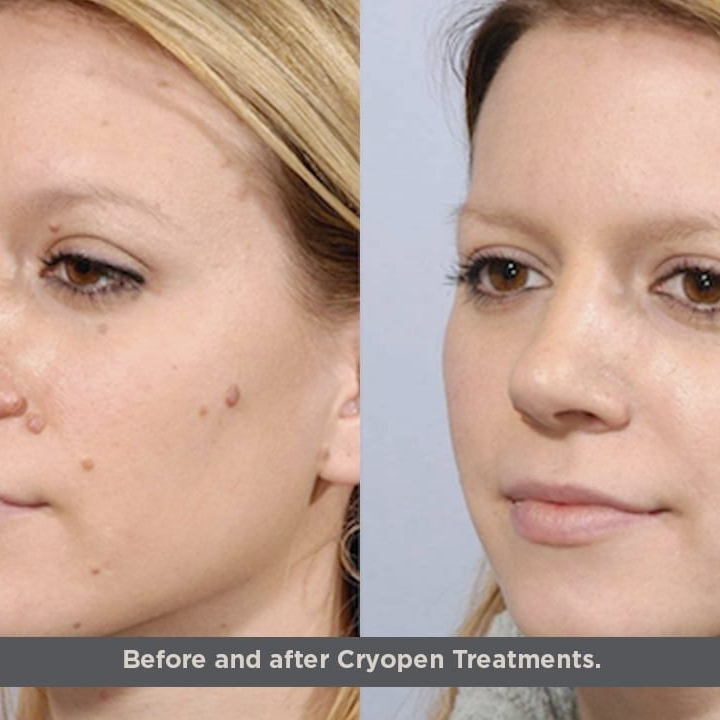 CryoPen treatment result image