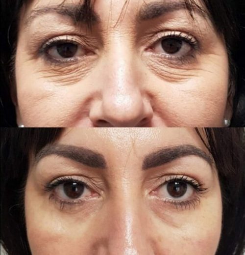 Sunekos treatment information for the eye area