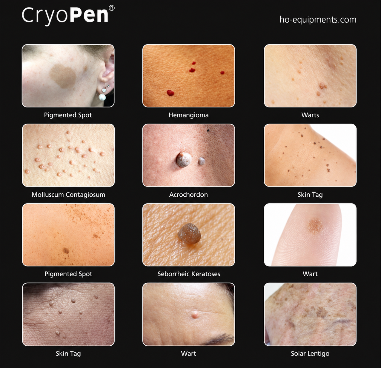 Examples of selected concerns that may be discussed at a CryoPen consultation