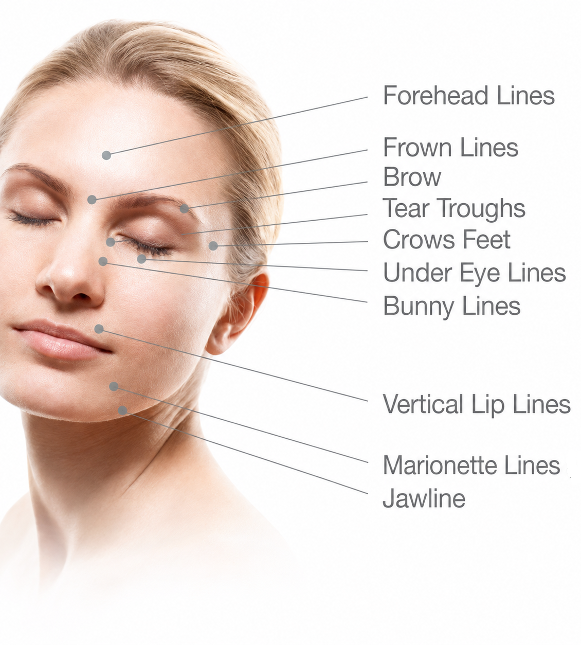Illustration of common anti-wrinkle treatment areas
