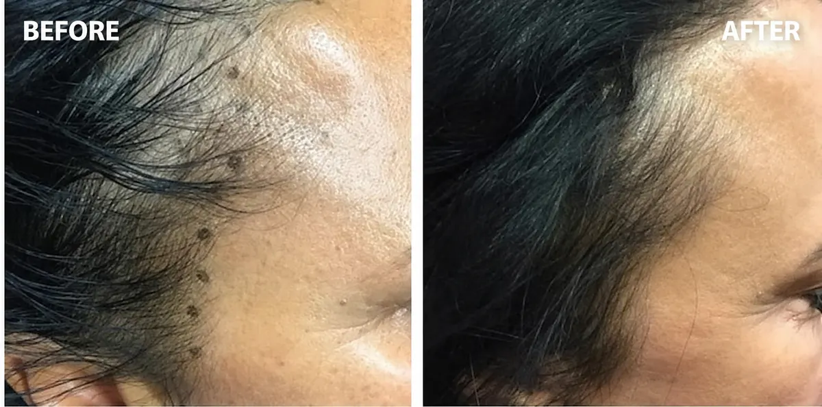 Hair-loss treatment 1