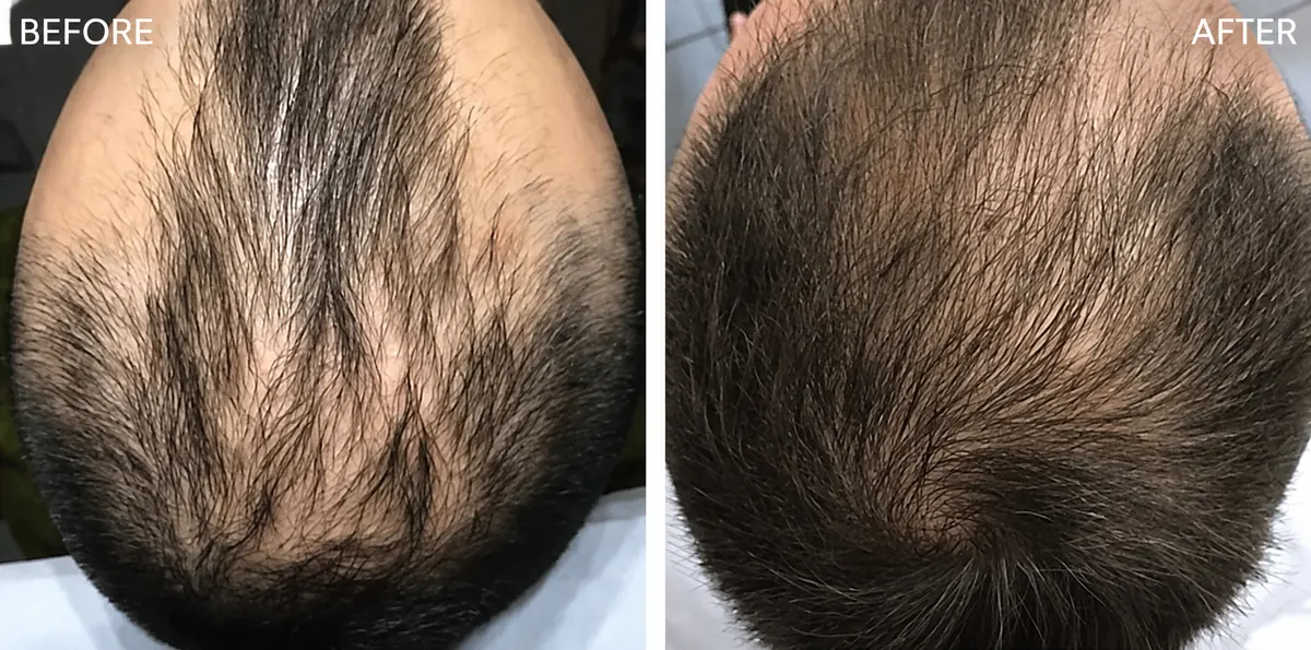Hair-loss treatment 12