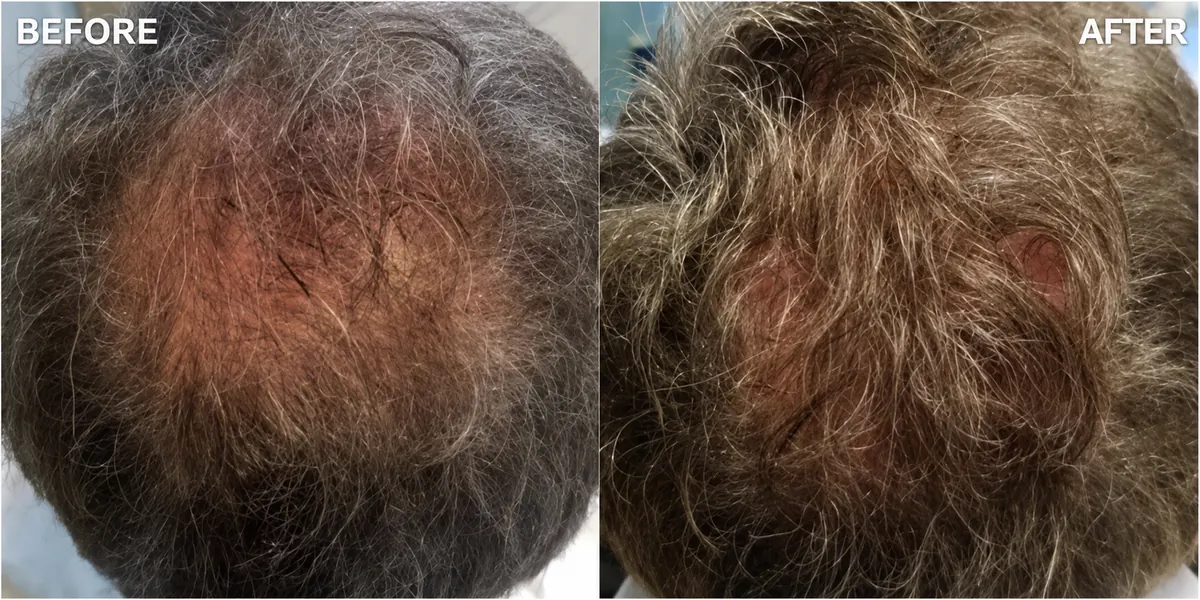 Hair-loss treatment 15