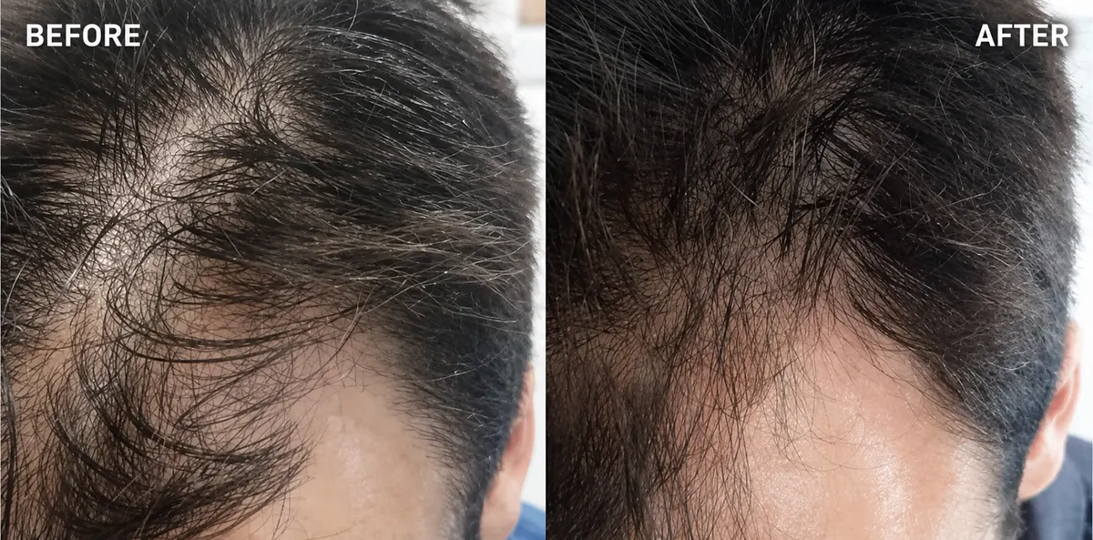 Hair-loss treatment 16