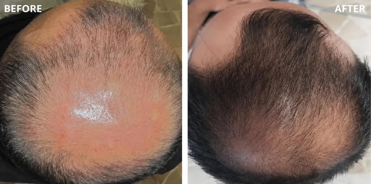Hair-loss treatment 2