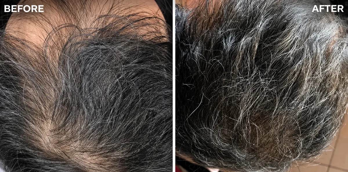 Hair-loss treatment 3