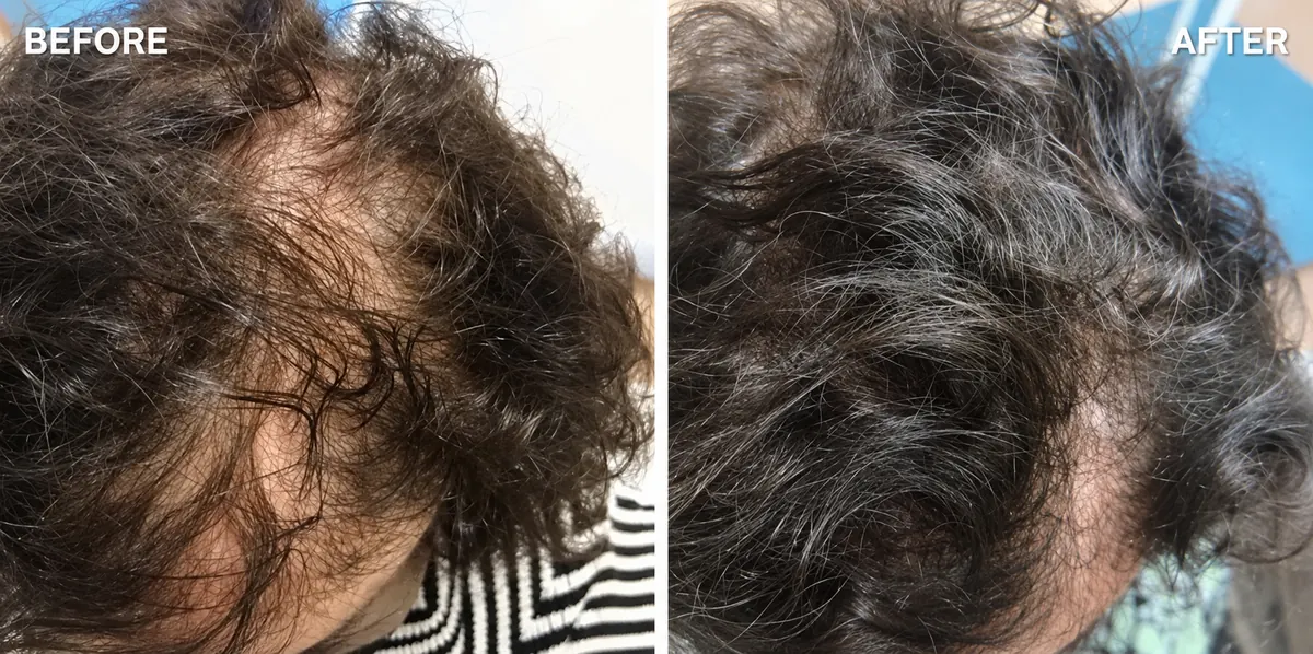 Hair-loss treatment 6