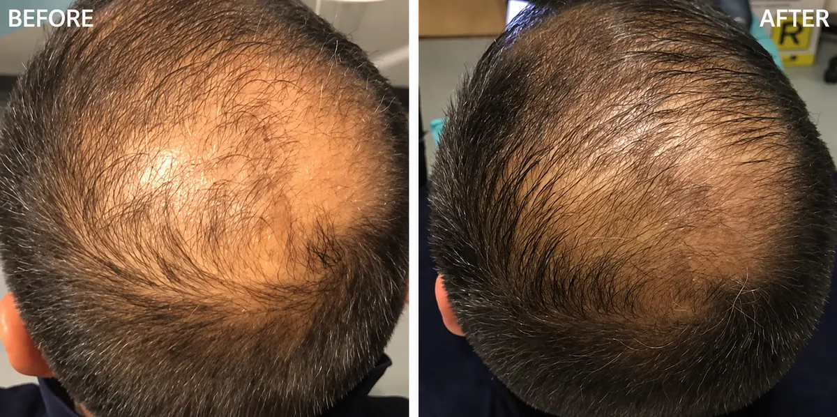 Hair-loss treatment 8