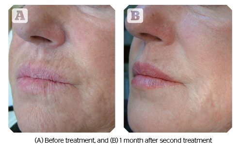 Profhilo treatment information