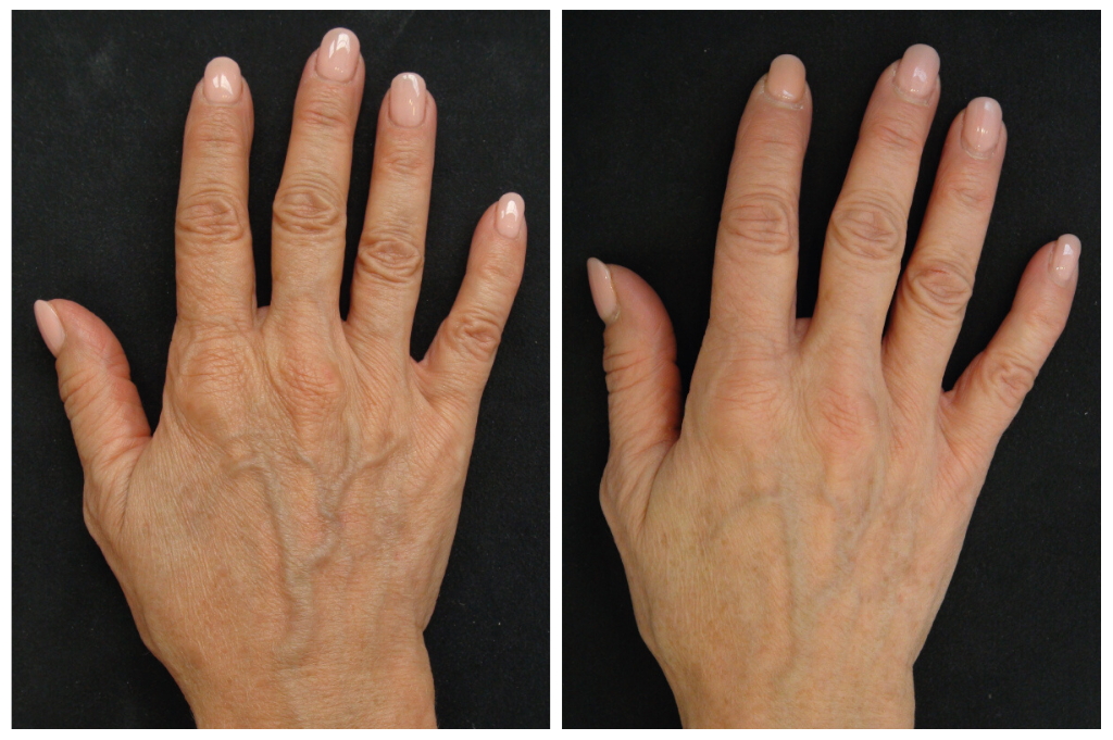 Profhilo treatment information
