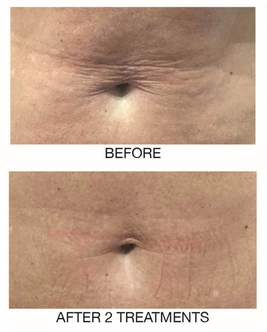 Profhilo skin booster treatment information