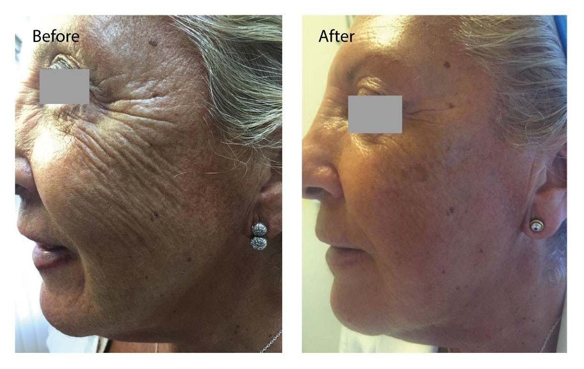 Profhilo treatment information