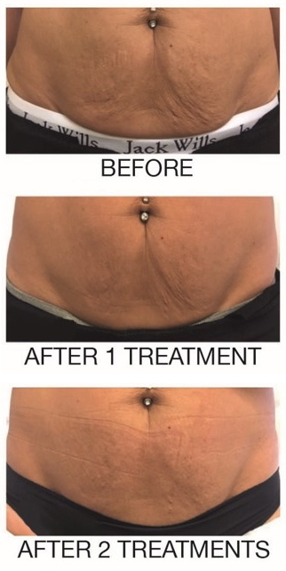 Skin booster treatment information