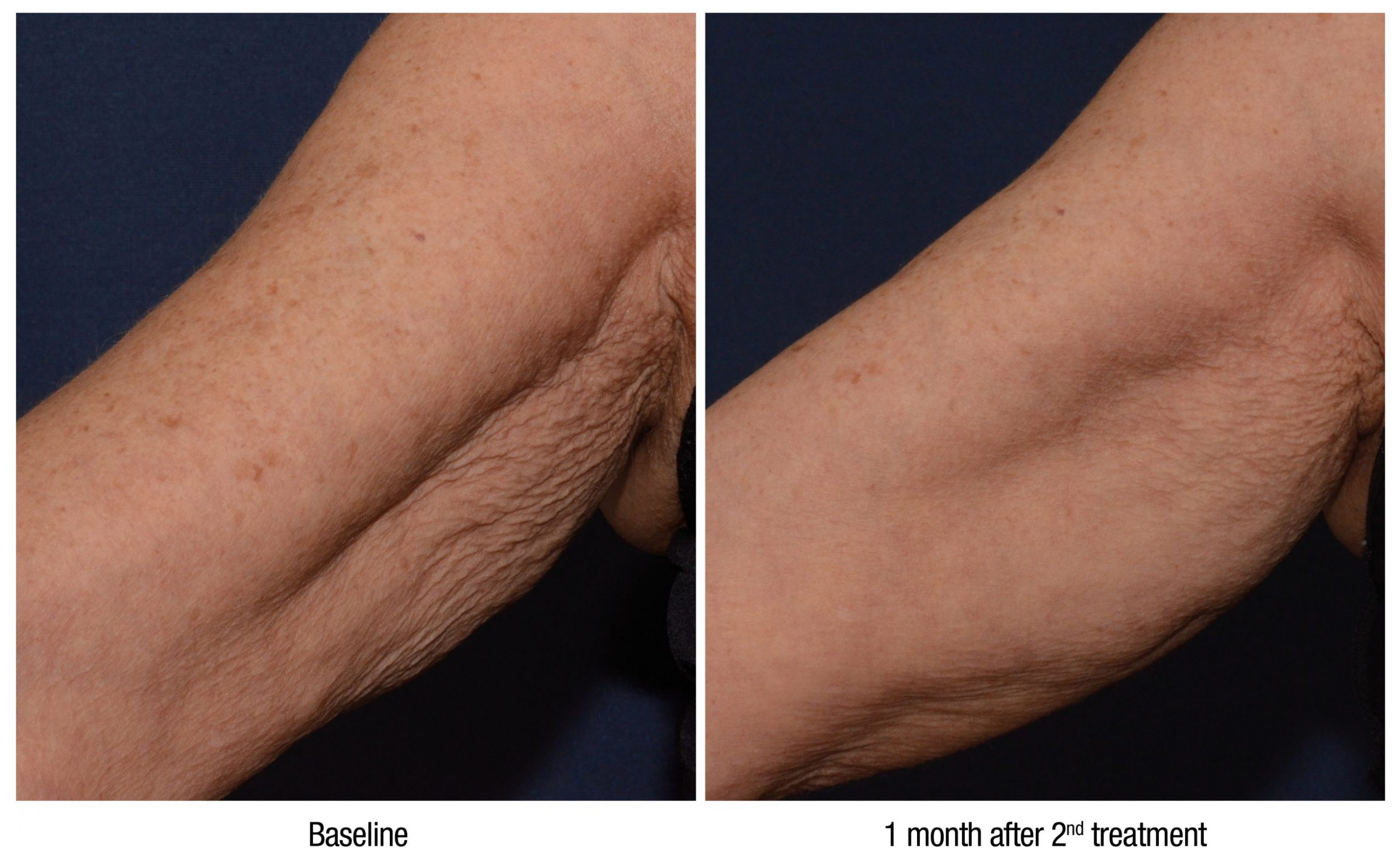 Skin booster treatment information