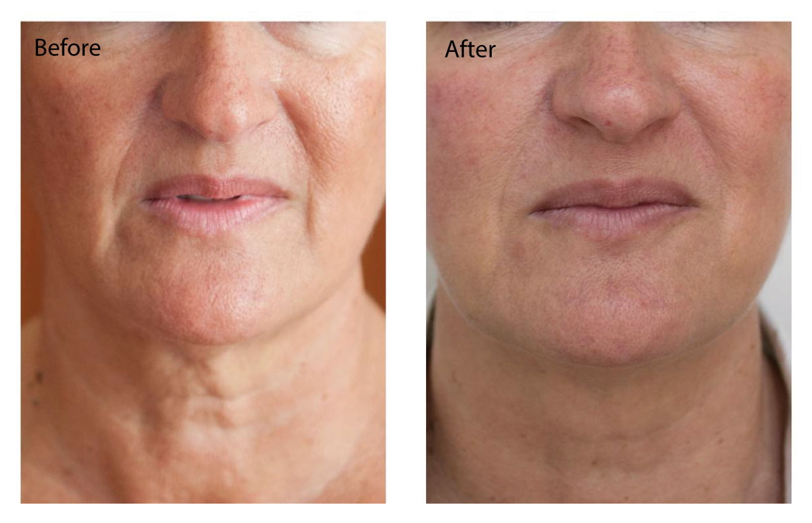 Skin booster treatment information