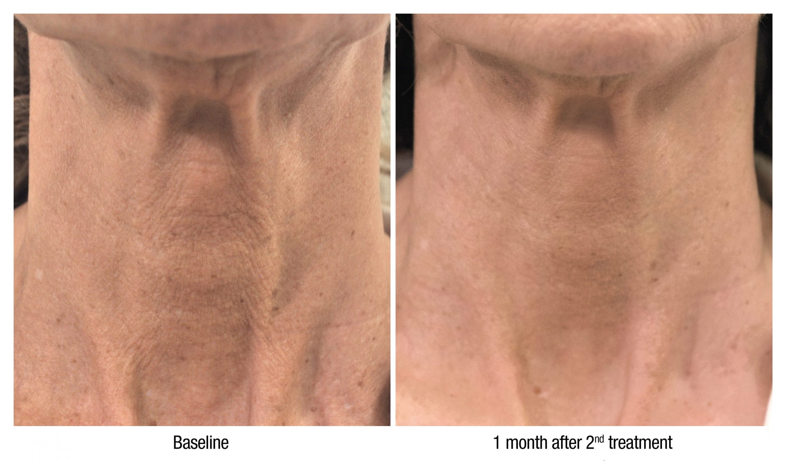 Skin booster treatment information