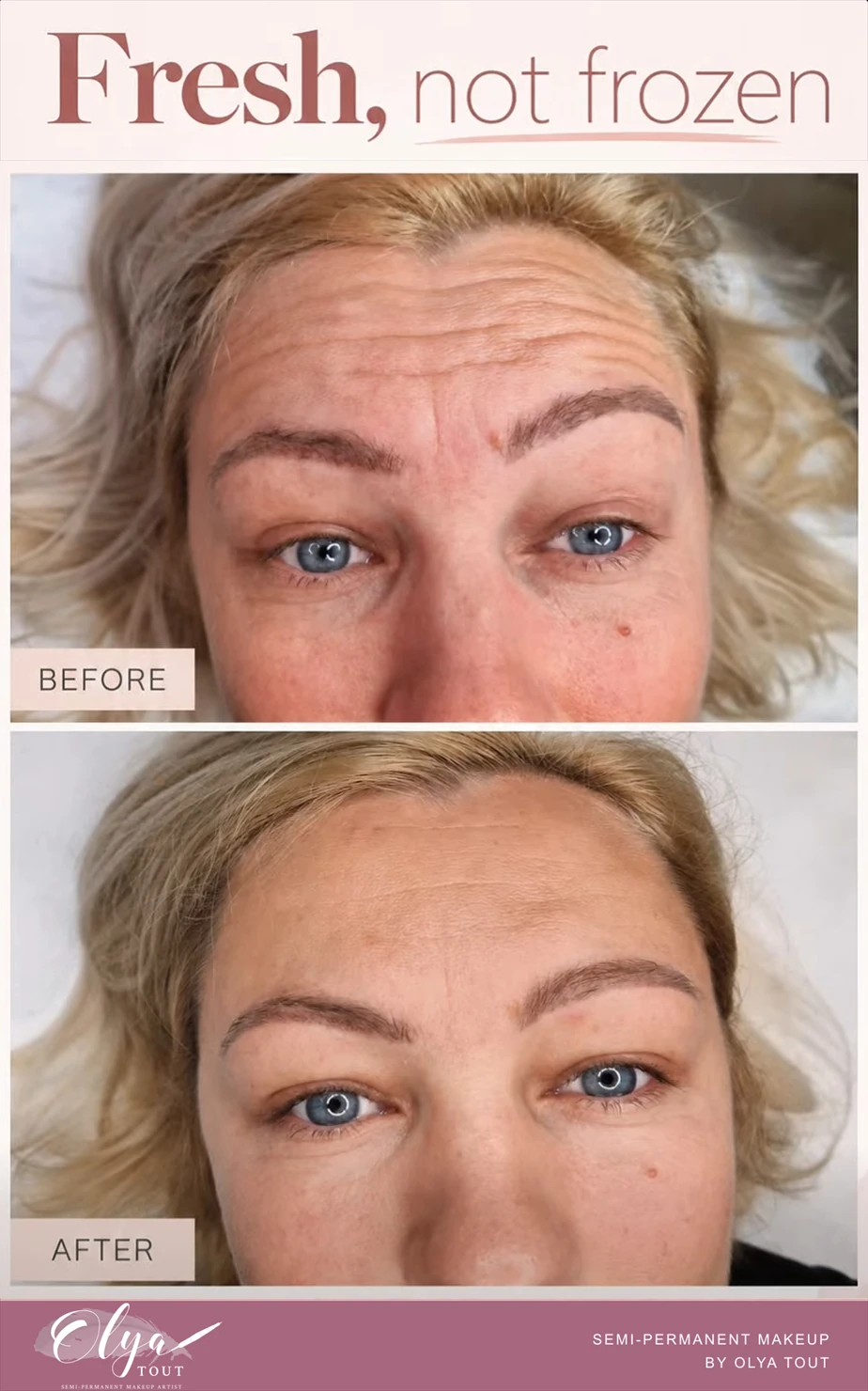 Before-and-after close-up of a client's forehead and eye area, showing expression lines before and smoother-looking skin after.