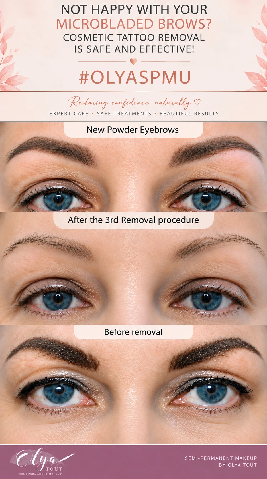 Edited three-panel eyebrow illustration labelled before removal, after the third removal procedure and new powder eyebrows.